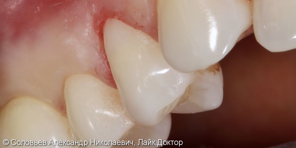 Лечение клиновидного дефекта 14 зуба - фото №2