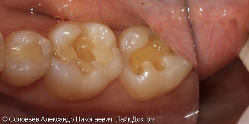 Лечение глубокого кариеса зубов 46 и 47 - фото №1