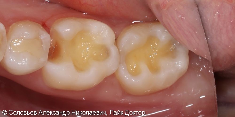 Лечение глубокого кариеса зубов 46 и 47 - фото №2