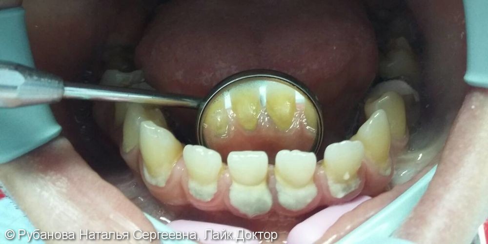 Чистка зубов ультразвуком и Air Flow, до и после - фото №1