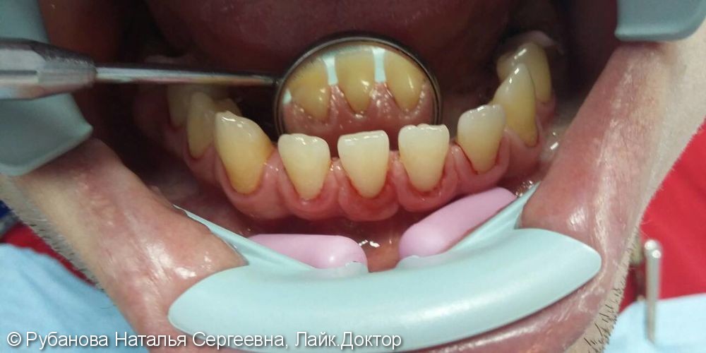 Чистка зубов ультразвуком и Air Flow, до и после - фото №2