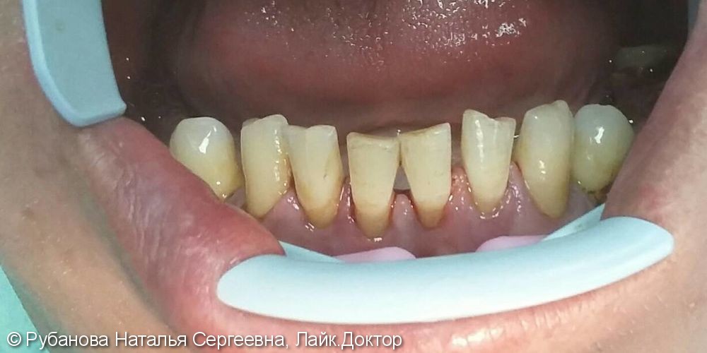 Профессиональная гигиена зубов, результат до и после - фото №2
