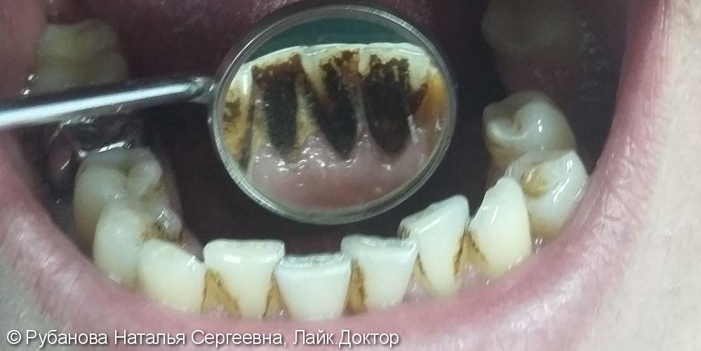 Результат снятия зубных отложений зубов, до и после - фото №1