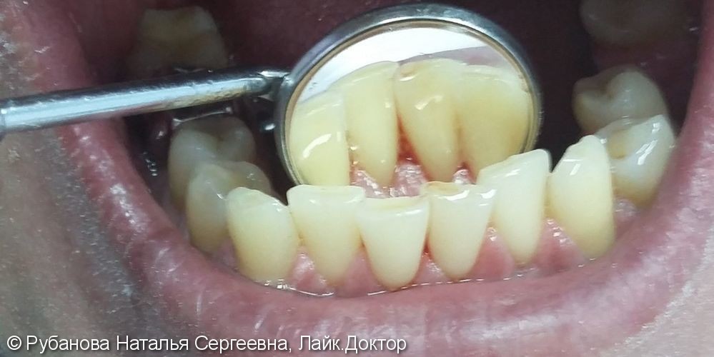 Результат снятия зубных отложений зубов, до и после - фото №2