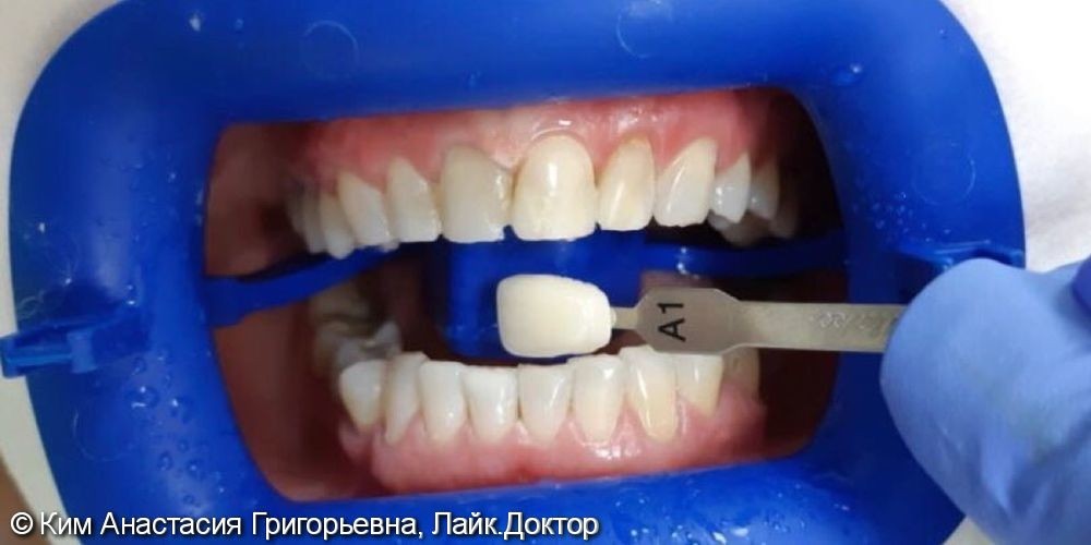 Профессиональная гигиена полости рта и отбеливание, результат до и после - фото №2
