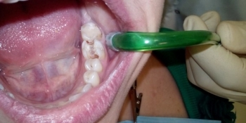 Глубокая кариозная полость зуба 3.6 - фото №1