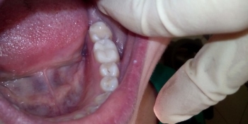 Глубокая кариозная полость зуба 3.6 - фото №2