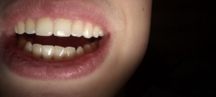 Эстетические реставрации зубов - фото №2