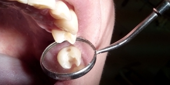 Реставрация зуба представлена материалом Kerr Herculite - фото №1