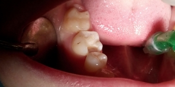 Реставрация зуба, поражено 2/3 части зуба - фото №1