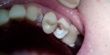 Реставрация зубов 2.3, 2.5 под инфраорбитальной анестезией - фото №1