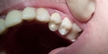 Реставрация зубов 2.3, 2.5 под инфраорбитальной анестезией - фото №2