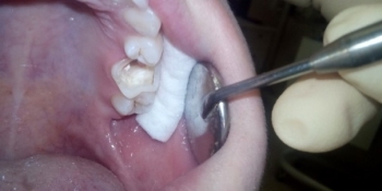 Восстановление анатомической целостности зуба - фото №1