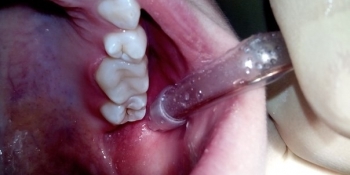 Восстановление анатомической целостности зуба - фото №2