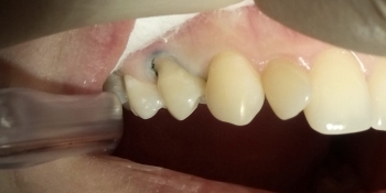 Лечение клиновидного дефекта зуба 1.4 - фото №1