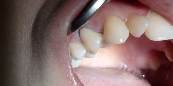 Лечение клиновидного дефекта зуба 1.4 - фото №2