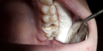 Лечение глубокого кариеса зуба 2.6 - фото №1