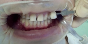 Отбеливание зубов Opalescence Boost - фото №1