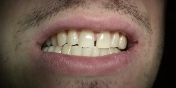 Отбеливание зубов Opalescence Boost - фото №2