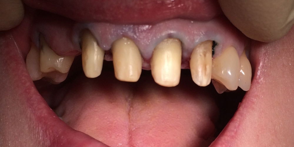Мостовидное протезирование 6 передних зубов - фото №1