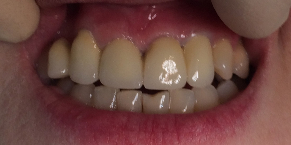 Мостовидное протезирование 6 передних зубов - фото №2