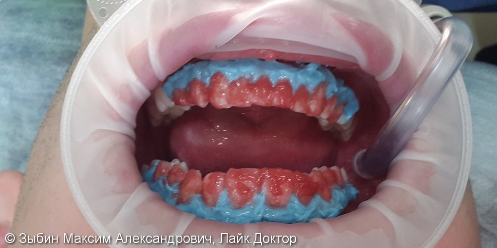 Результат отбеливание зубов системой Opalescence Boost - фото №1