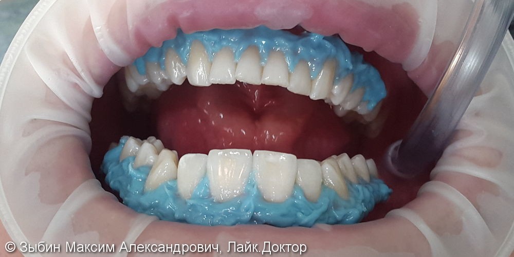 Химическое отбеливание зубов opalescence boost отзывы зубная щетка орал би ай о цена