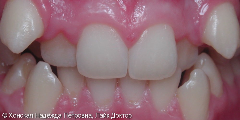 Выраженная скученность зубов в переднем отделе верхней и нижней челюстях - фото №1