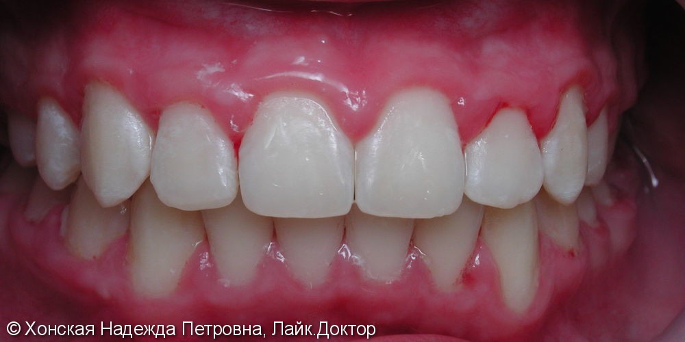 Выраженная скученность зубов в переднем отделе верхней и нижней челюстях - фото №2