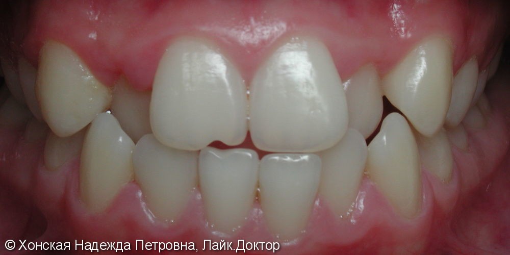 Скученное положение зубов, до и после лечения - фото №1