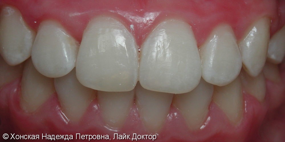 Скученное положение зубов, до и после лечения - фото №2