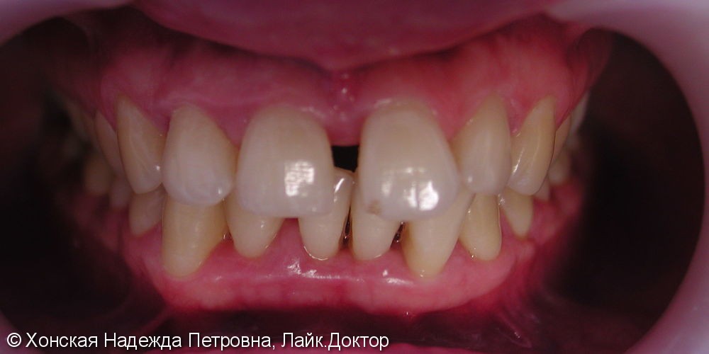 Жалобы на расхождение зубов во фронтальном отделе - фото №1