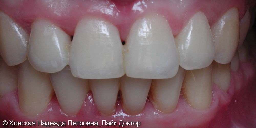 Жалобы на расхождение зубов во фронтальном отделе - фото №2