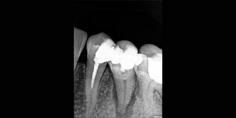 Спасение зуба от удаления - фото №1