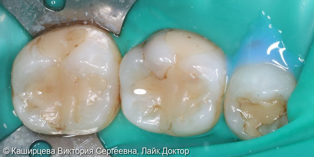 Лечение 4.5, 4.6, 4.7 зубов - фото №1