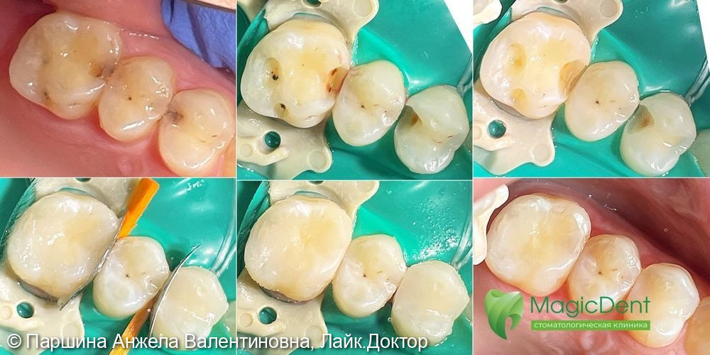 Клинический случай лечения кариеса сразу двух (24 и 26) зубов - фото №1