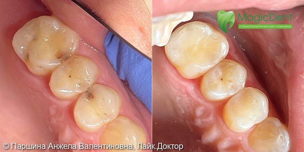 Клинический случай лечения кариеса сразу двух (24 и 26) зубов - фото №2