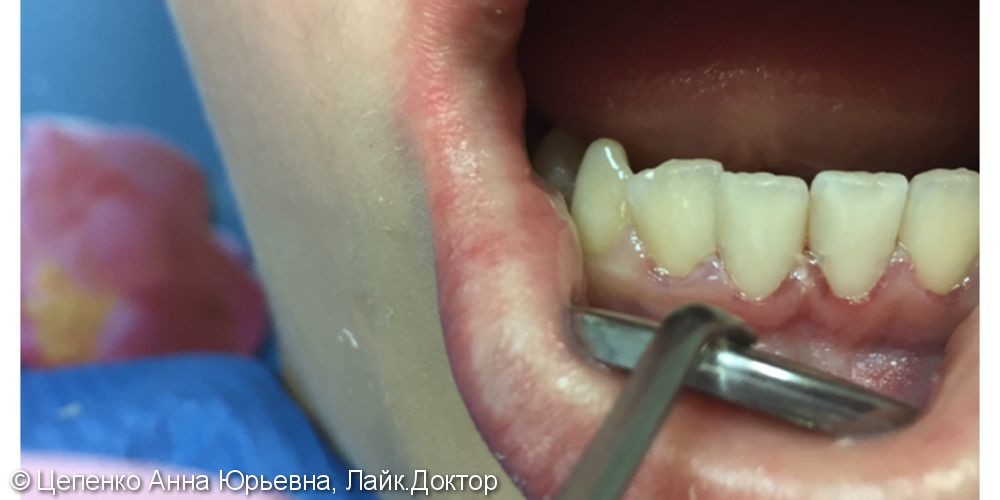 Лечение кариеса зубов 31, 32, 41, 42 - фото №3