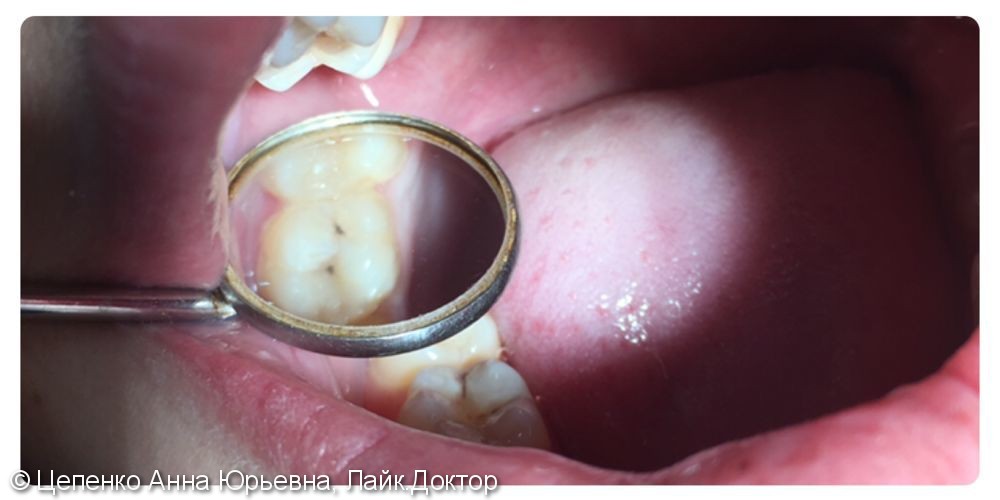 Лечение глубокого кариеса зуба 1.6 и среднего кариеса 1.5 зуба - фото №1
