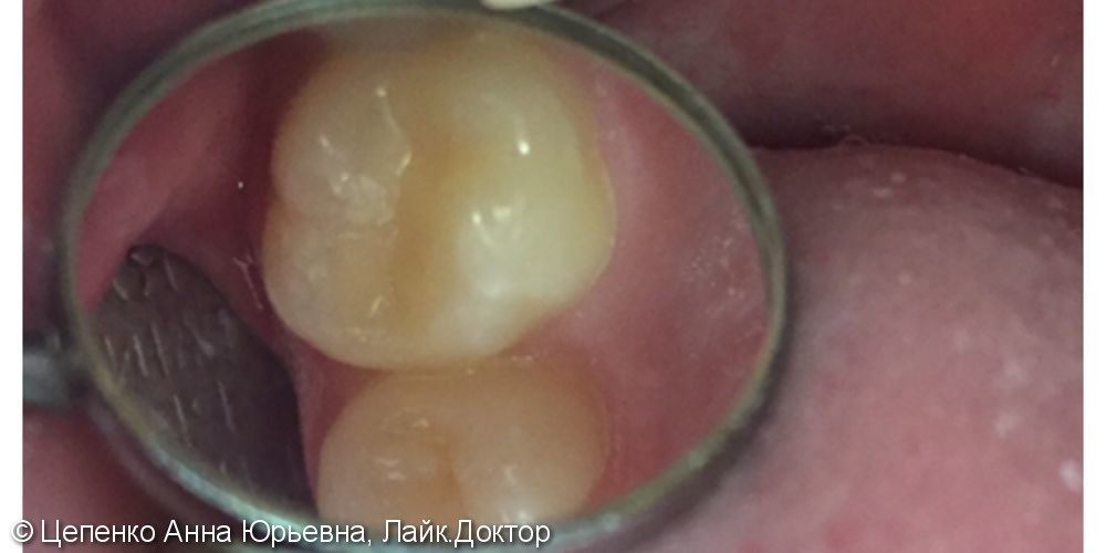 Лечение глубокого кариеса зуба 1.6 и среднего кариеса 1.5 зуба - фото №3