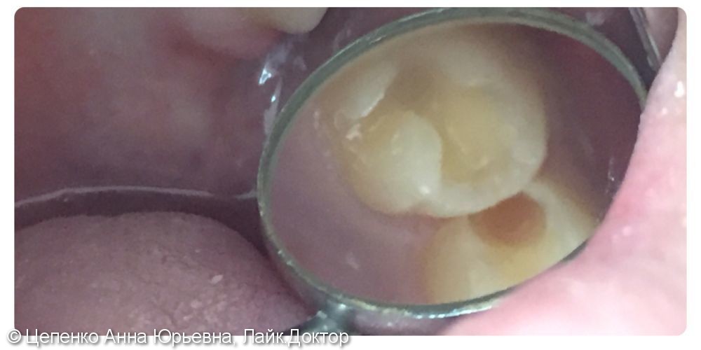 Лечение кариеса двух зубов в одно посещение - фото №2