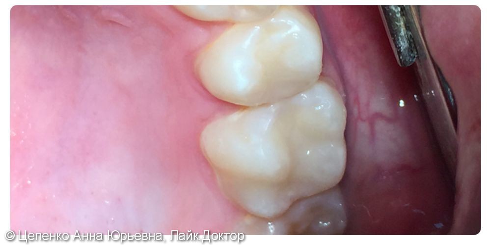 Лечение кариеса двух зубов в одно посещение - фото №3