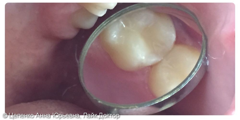 Лечение кариеса двух зубов в одно посещение - фото №4