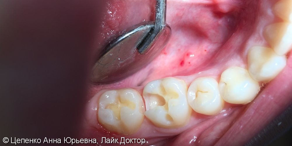 Лечение зубов 4.6 и 4.7 - фото №3