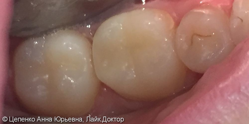 Лечение зубов 4.6 и 4.7 - фото №5