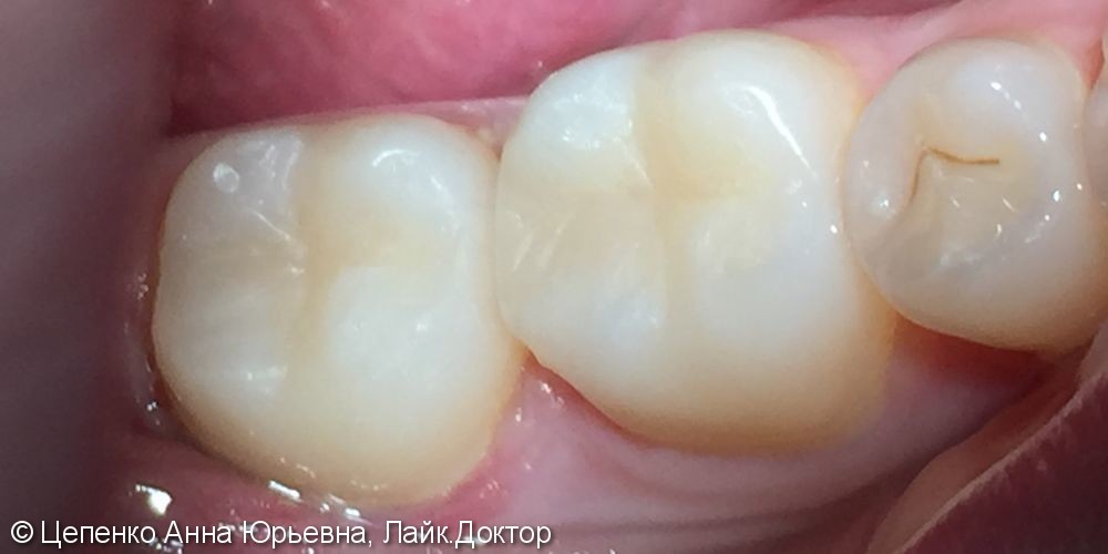 Лечение зубов 4.6 и 4.7 - фото №6