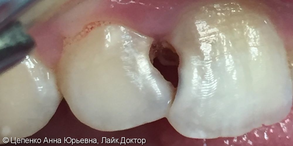Лечение хронического пульпита зубов 1.1;1.2 - фото №1