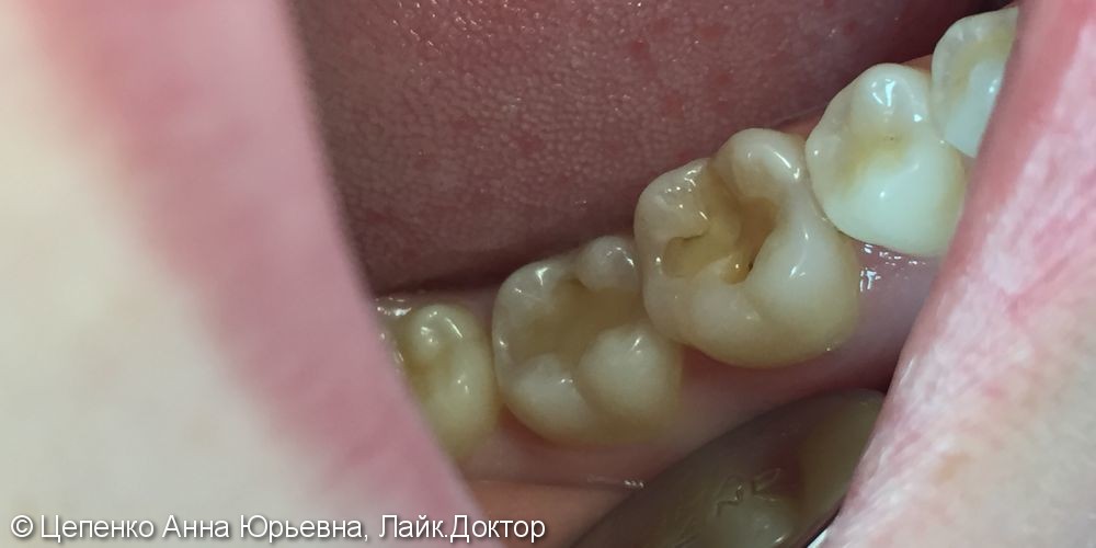 Дефект пломб зубов 4.6,4.7 - фото №1