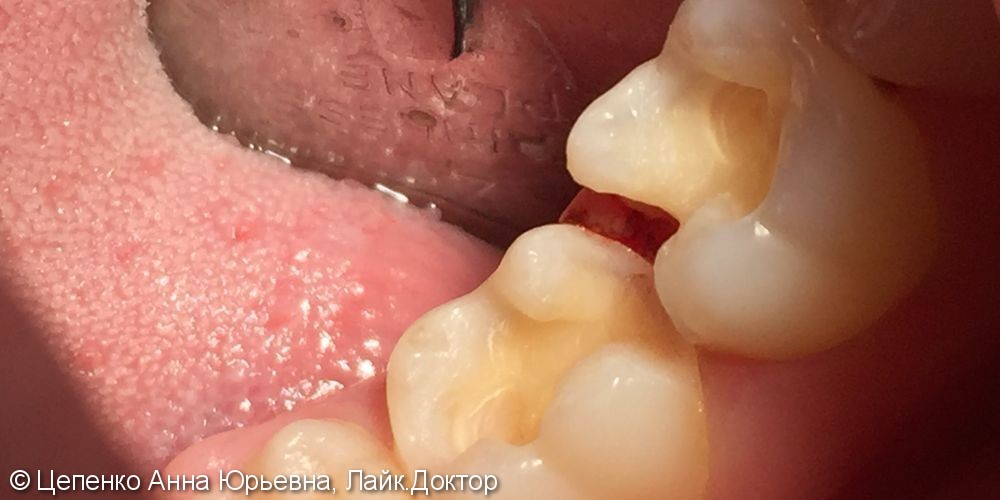 Дефект пломб зубов 4.6,4.7 - фото №2