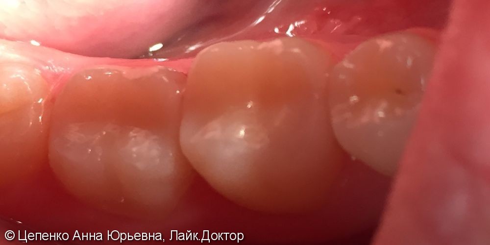 Дефект пломб зубов 4.6,4.7 - фото №4